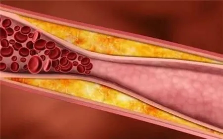 动脉硬化的征兆、原因及治疗方法